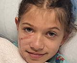 Pit bull attack - Zoey Green